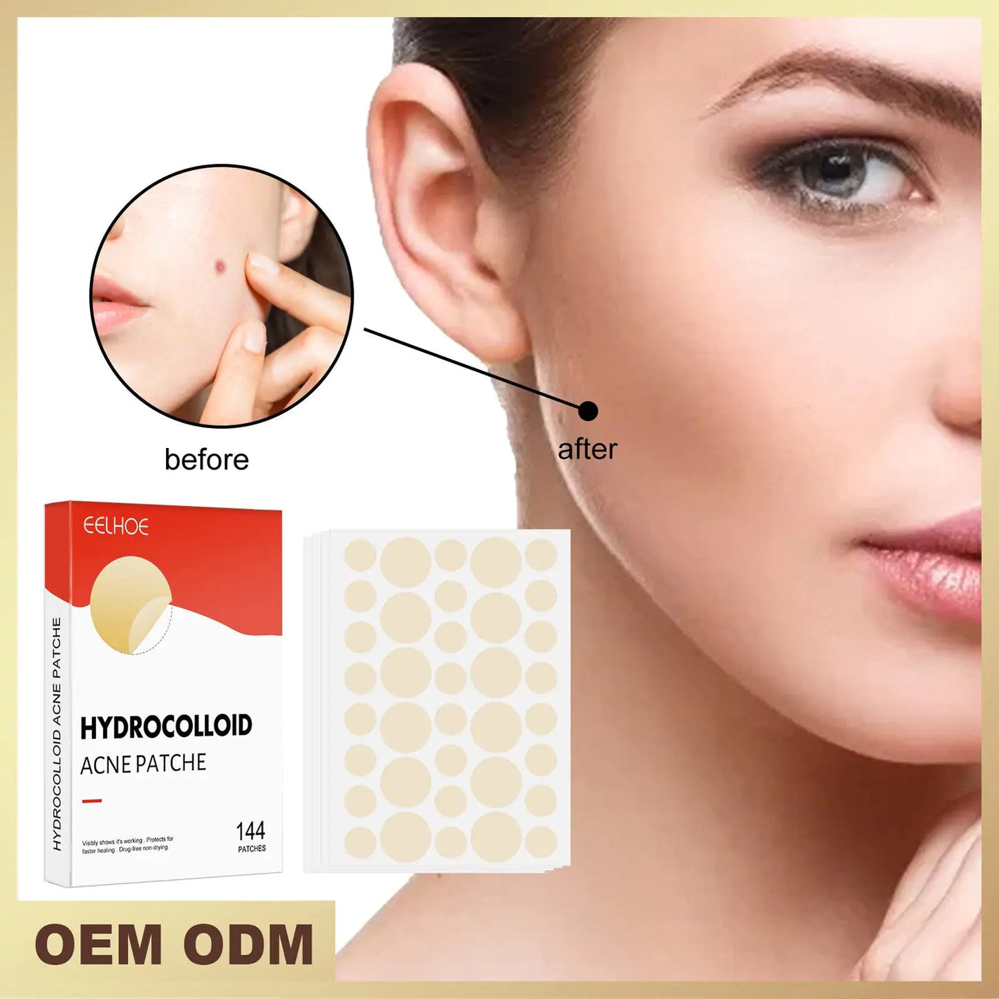 Hydrocolloid Acne Patches