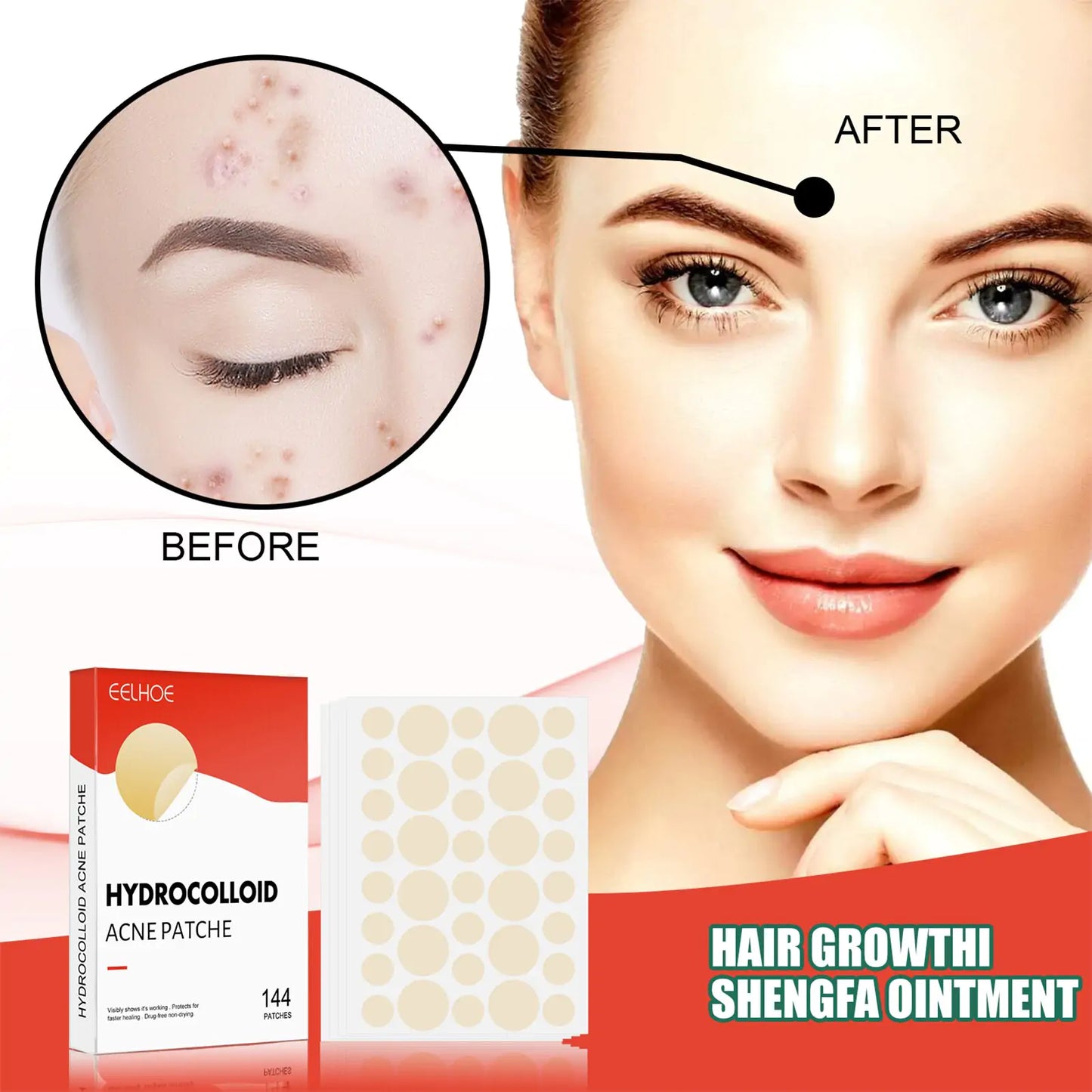 Hydrocolloid Acne Patches